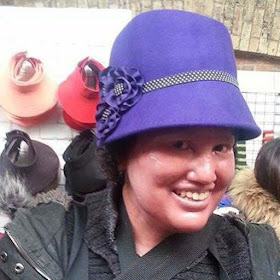 carly findlay in a purple hat