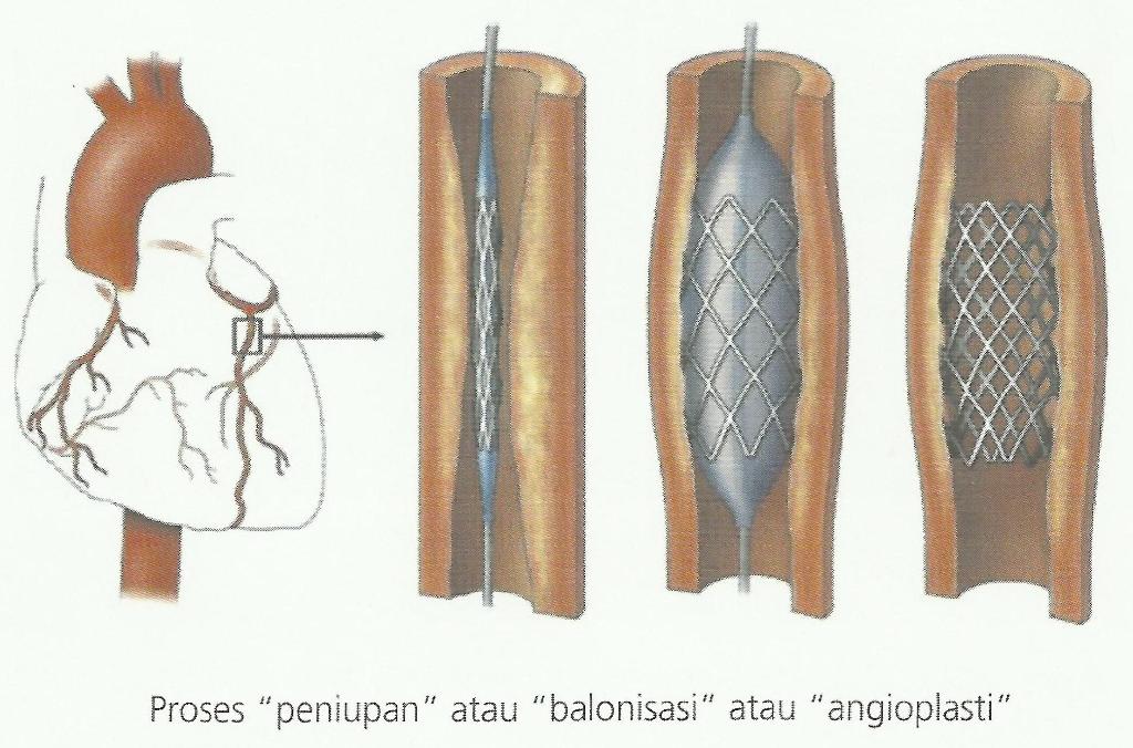 Kateterisasi Jantung LDII KOTA BANDUNG