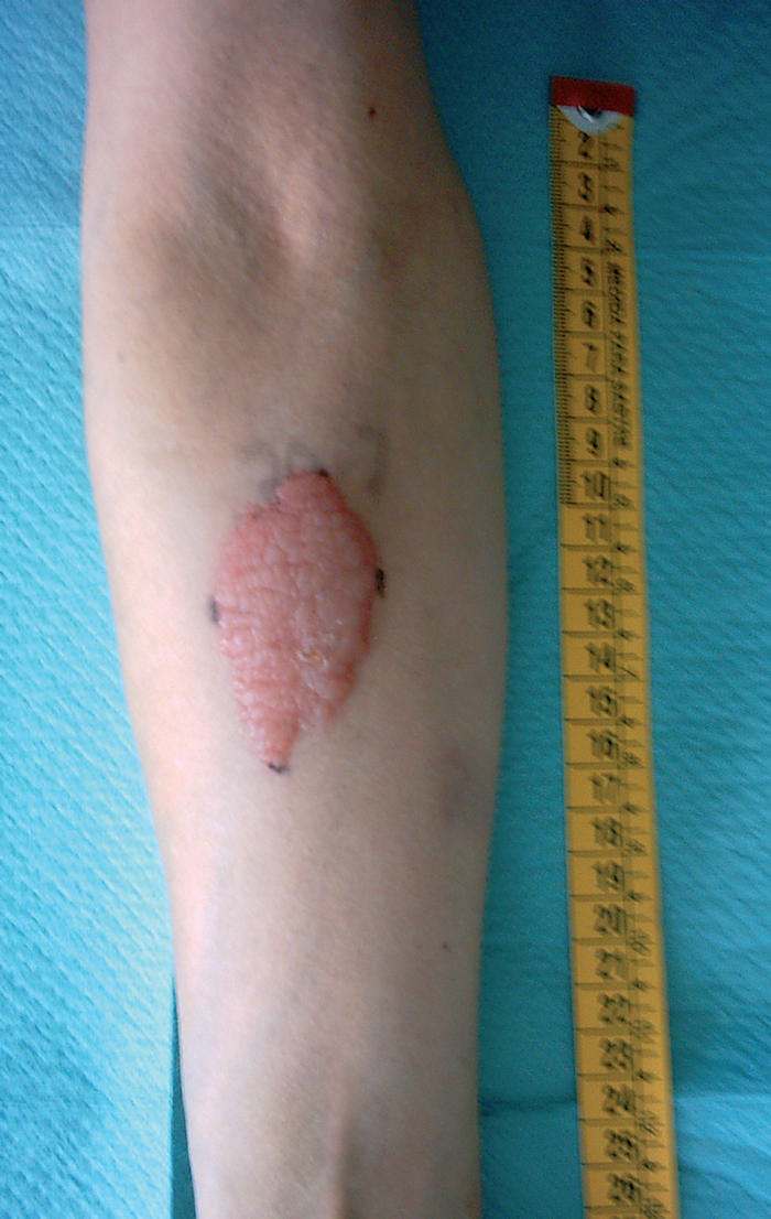 TUBERCULOSIS TUBERCULOSIS