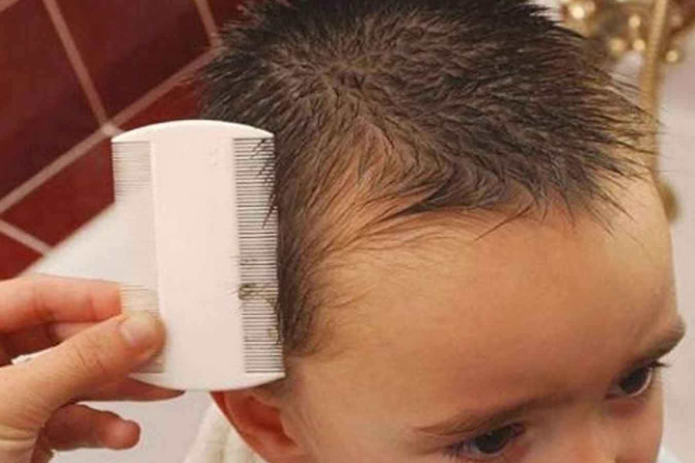 детский педикулез