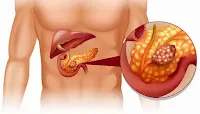  سرطان البنكرياس Pancreas cancer