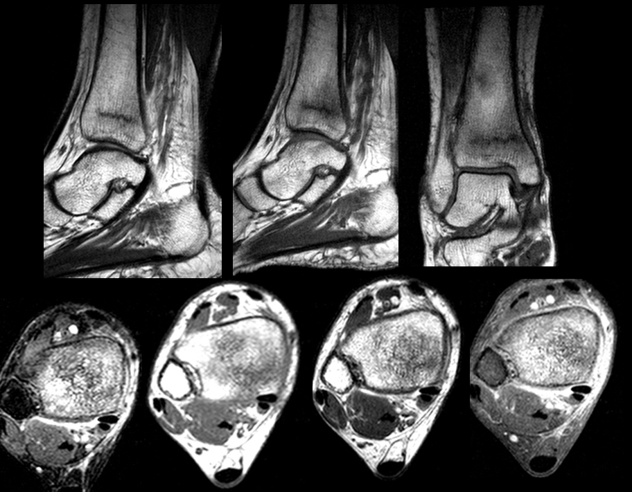 tibial stress fracture tibial stress fracture