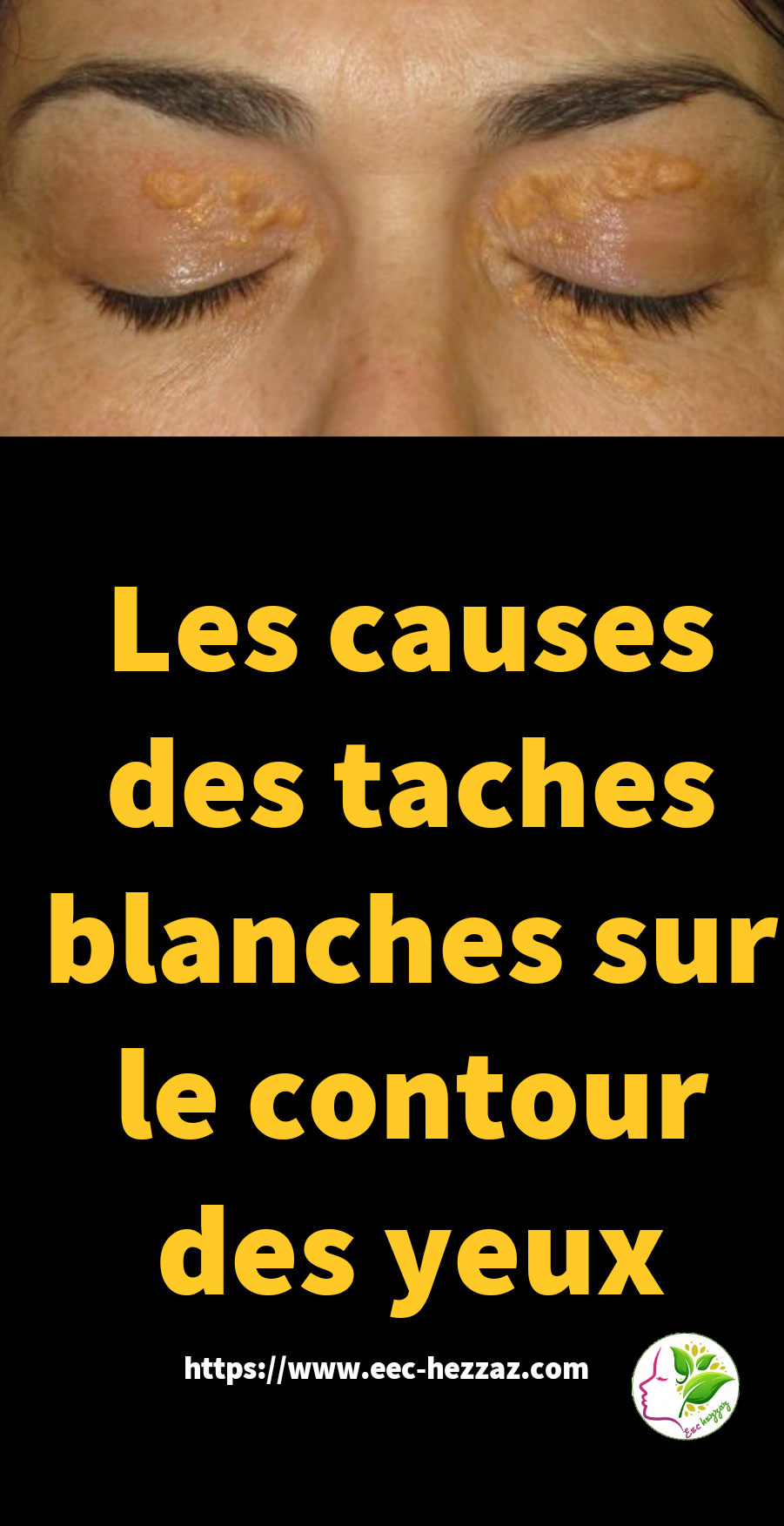 Les causes des taches blanches sur le contour des yeux
