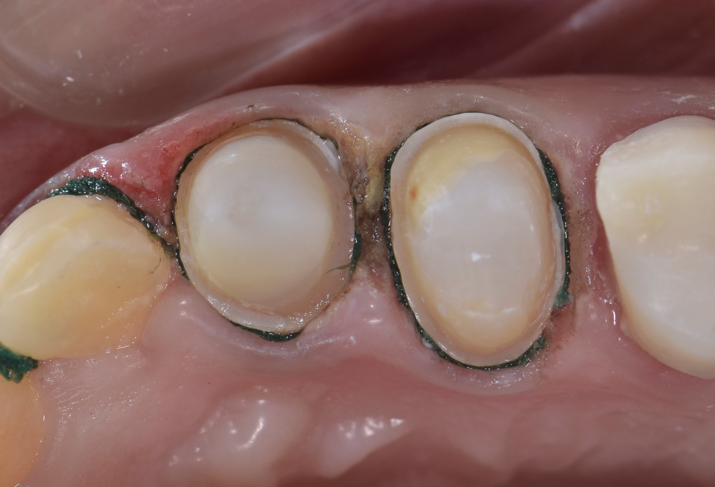 Retraction cords.. Why? When? How? Dental Esthetics