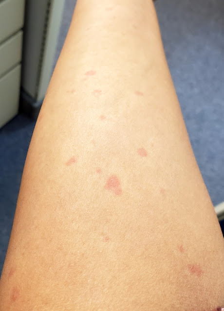 itchy little red dots on my skin
