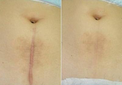 Đánh bay sẹo lồi bằng 5 sản phẩm đặc trị sau Đánh bay sẹo lồi bằng 5 sản phẩm đặc trị sau