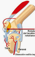 ruptura de tendon