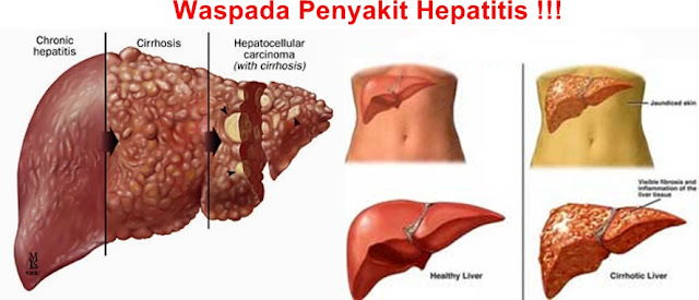 Obat Hepatitis Herbal, Paling Ampuh Menyembuhkan Hepatitis Secara Alami Sampai Tuntas : QnC Jelly Gamat Solusinya