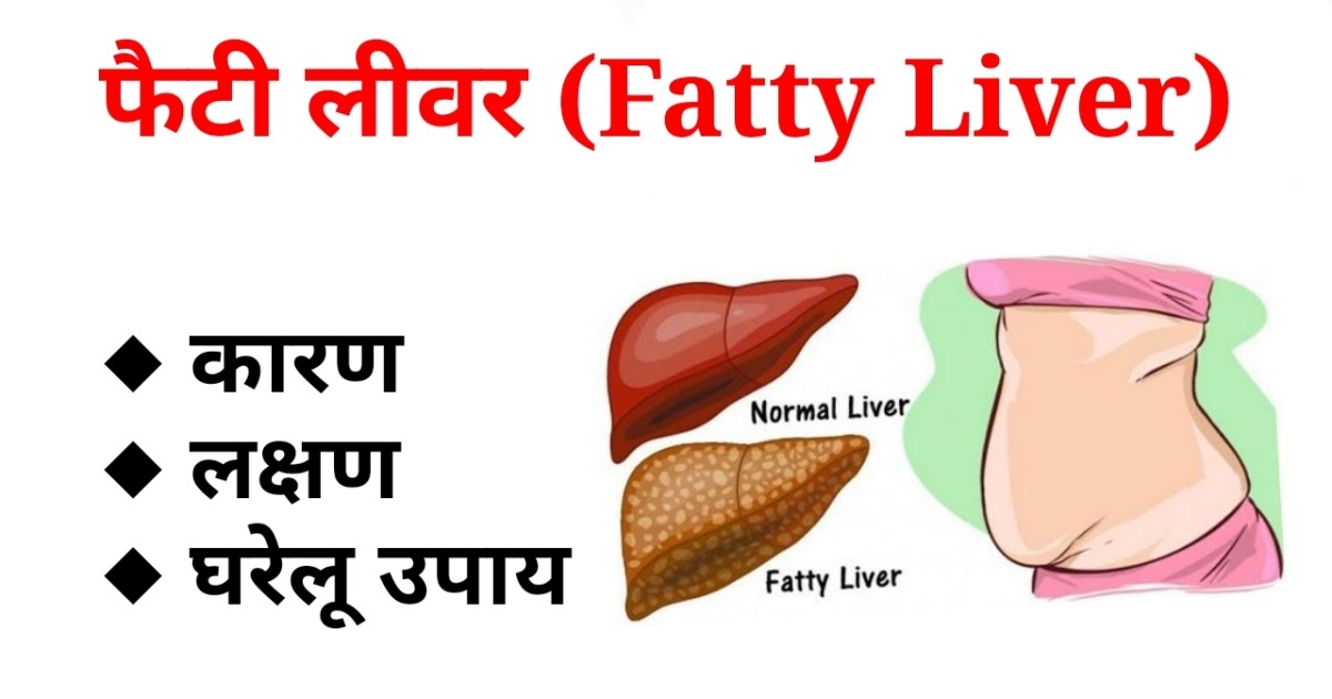  फैटी लिवर का इलाज घरेलू आयुर्वेदिक नुस्खों से :Fatty Liver ayurvedic ilaj 