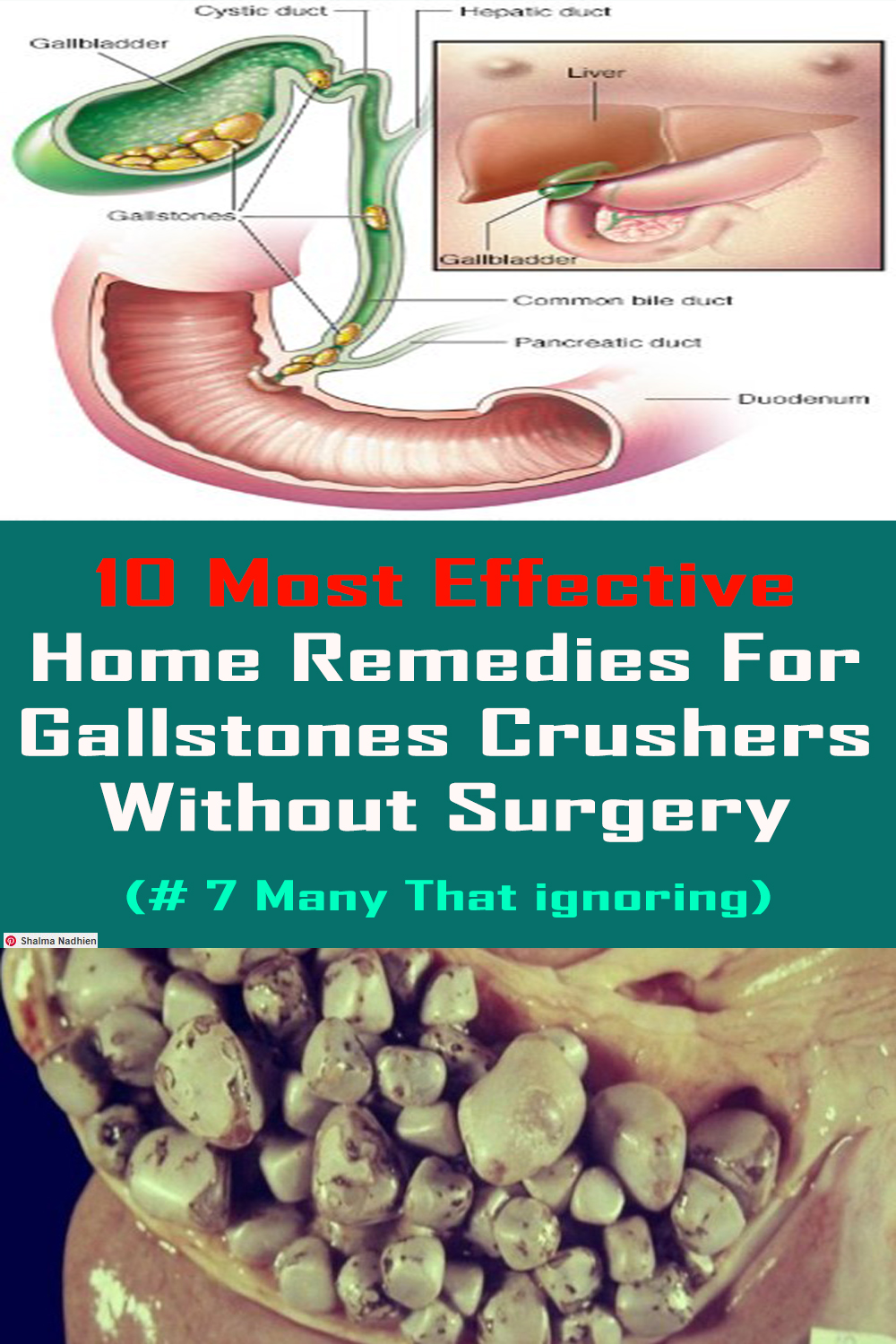 HOW TO DESTROY AND FLUSH ALL GALLSTONES NATURALLY WITHOUT ANY SURGERY