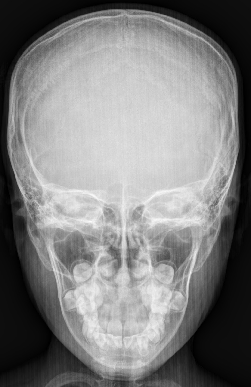 X Ray Cranium Indications soft Tissue Sweling Radiology Imaging