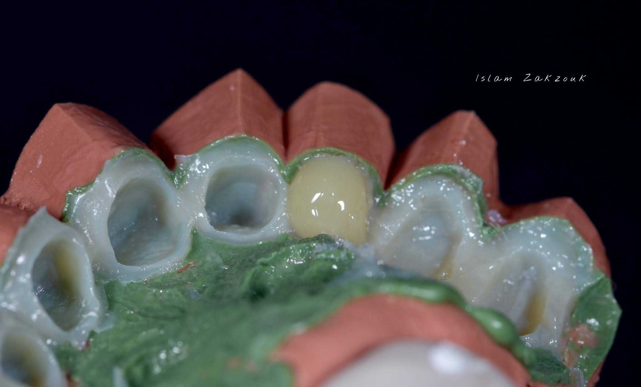 Dental Esthetics Ovate pontic for the correct emergence profile.. A clinical case