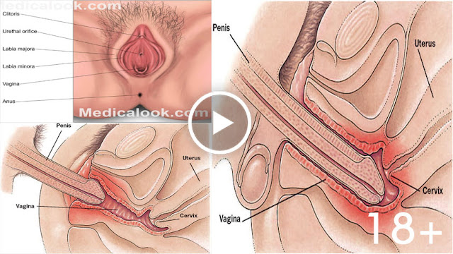 Central And Lateral Cystocele