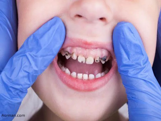 تسوس الأسنان عند الأطفال 5 سنوات .