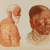 Leprosy: Pathogenesis and classification