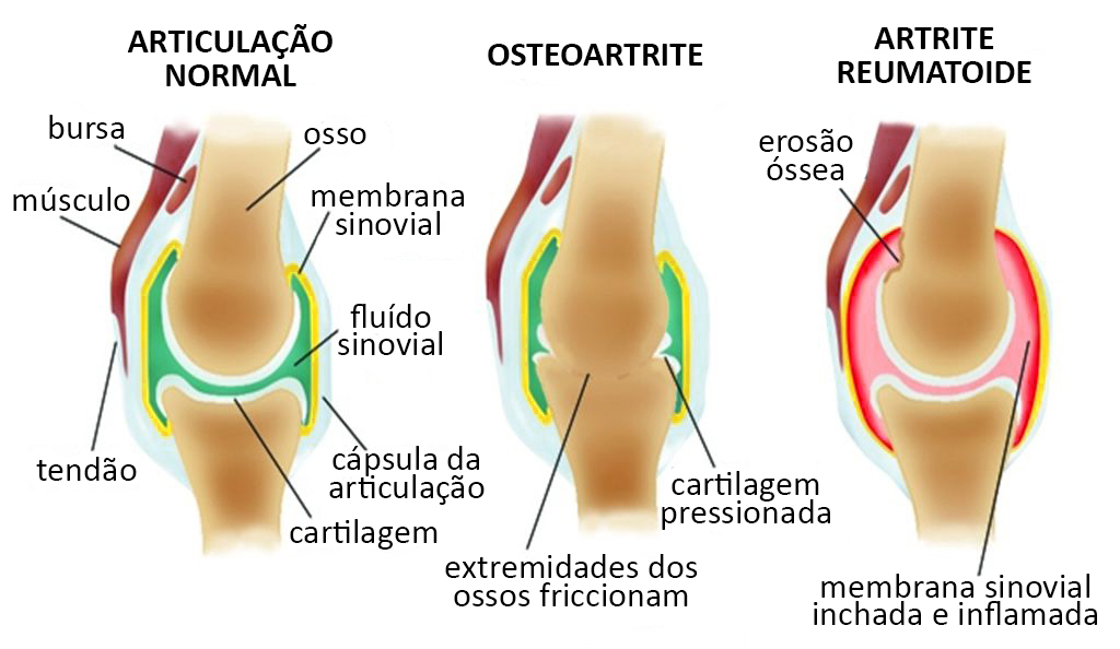 tratament articular antic