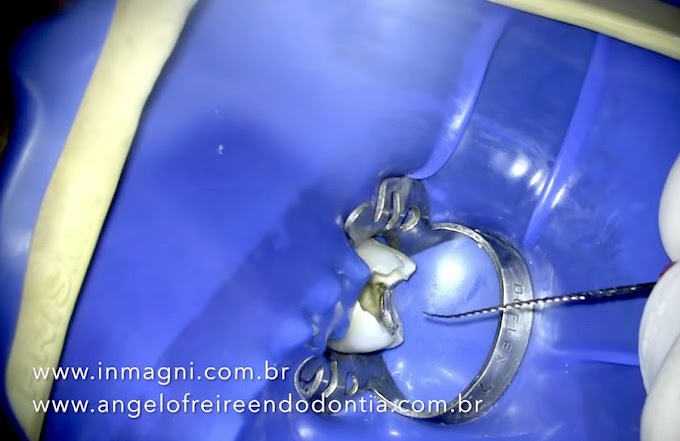 INSTRUMENTO FRATURADO: Remoção no forame de raiz palatina - Dr. Angelo Freire