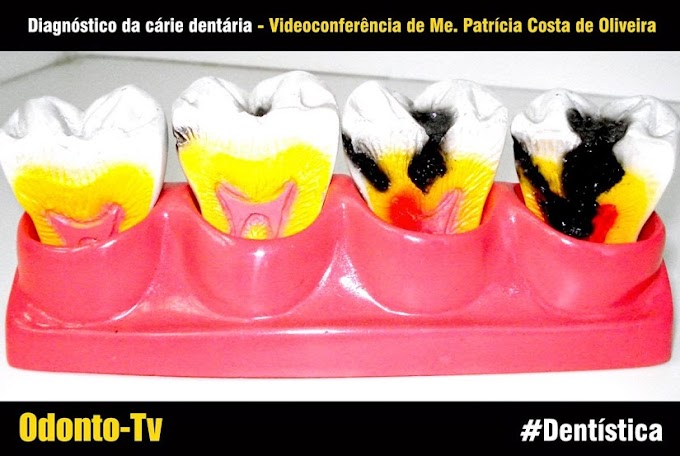 DENTÍSTICA: Diagnóstico da cárie dentária - Videoconferência de Me. Patrícia Costa de Oliveira