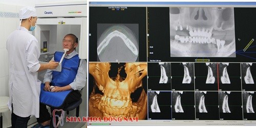 YẾU TỐ NÀO ĐẢM BẢO TRỒNG RĂNG IMPLANT ĐƯỢC THÀNH CÔNG -14