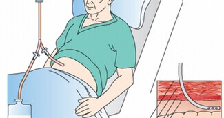 periton diyalizi nedir kimlere nasil