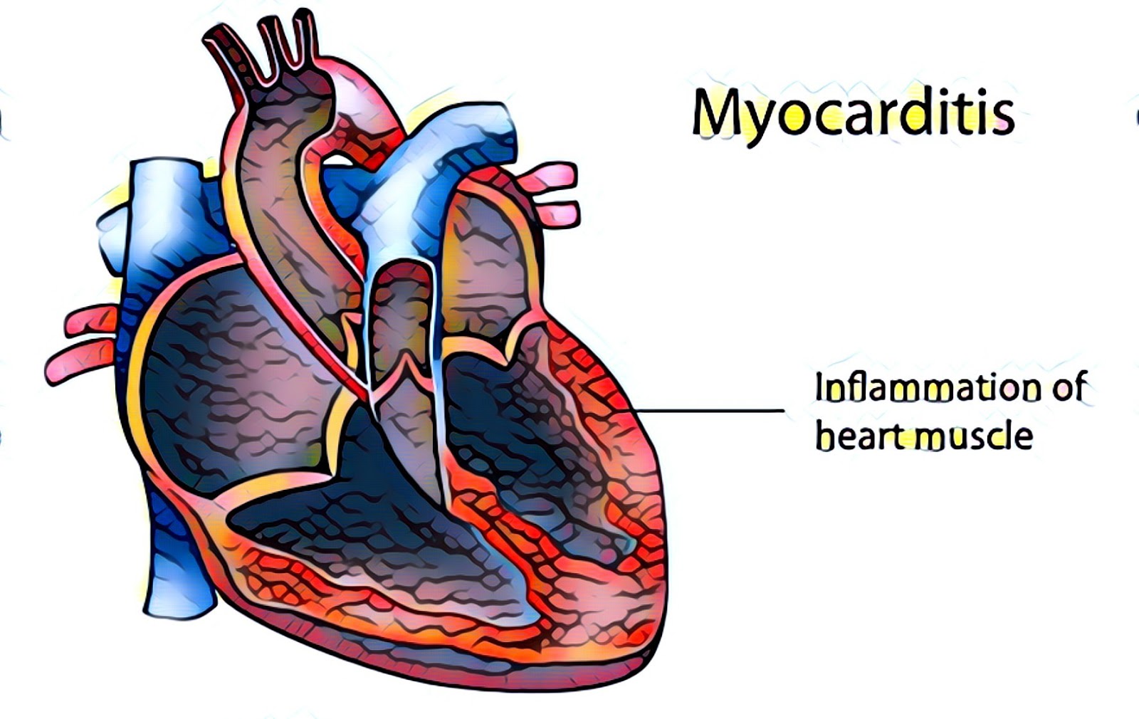 Myocarditis: Symptoms Causes, Possible Complications, And Ways To ...