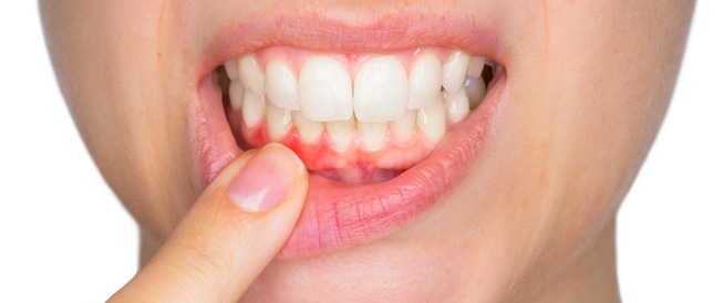 What is gingivitis and what are the ways to prevent it?