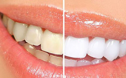 Nguy cơ tai biến khi lạm dụng thuốc tẩy trắng răng