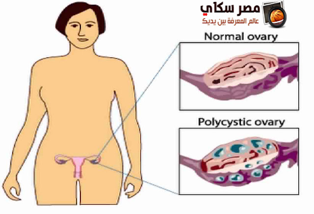 تكيس المبايض والأعراض والعلاج polycystic ovary