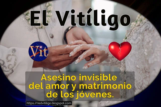 El vitiligo, asesino invisible del amor y matrimonio de los jóvenes