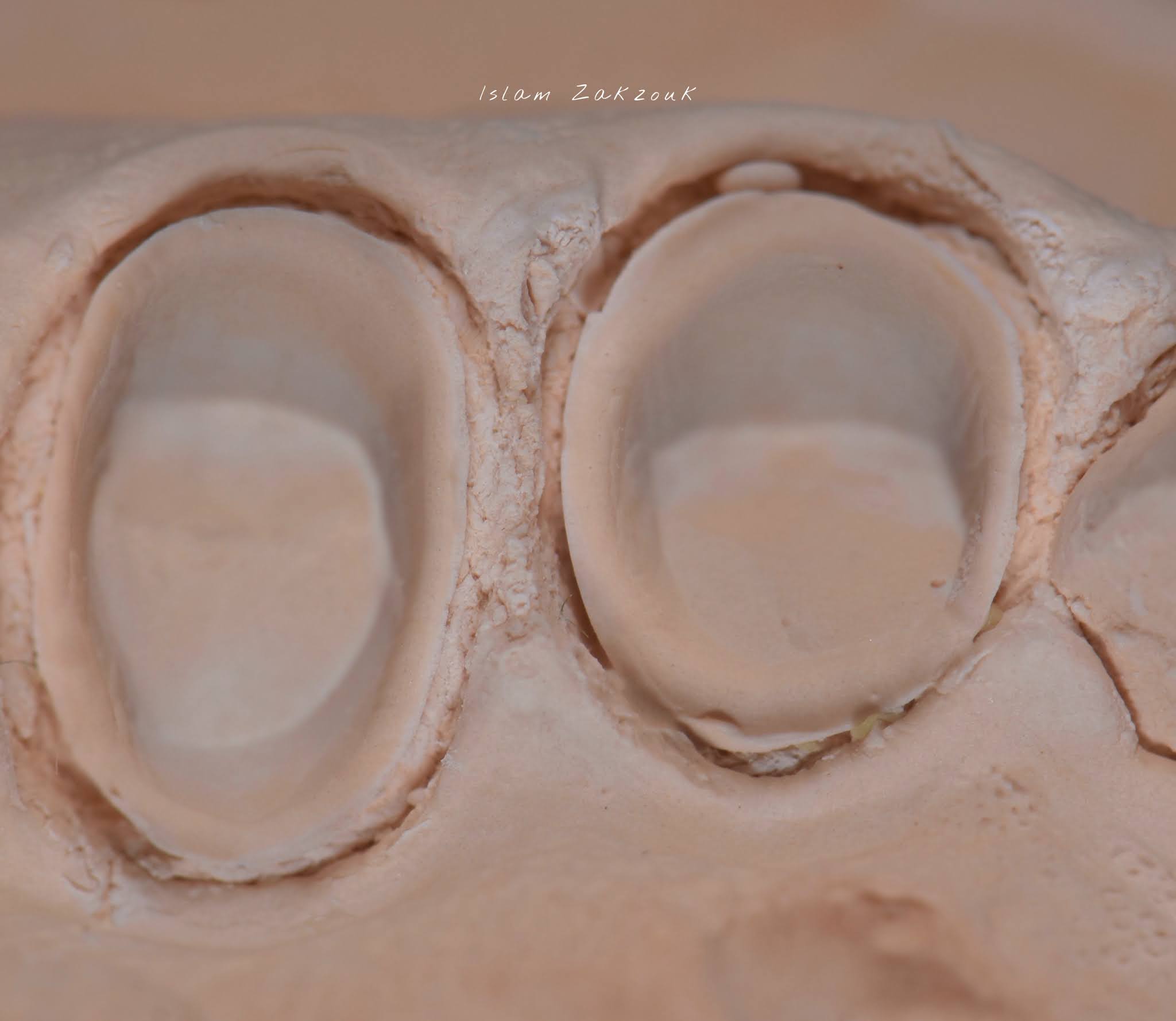 Retraction cords.. Why? When? How? Dental Esthetics