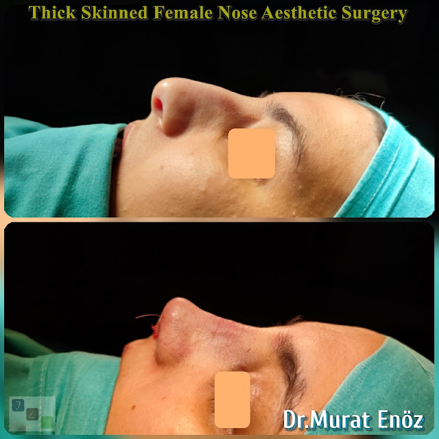 female nose asthetic surgery