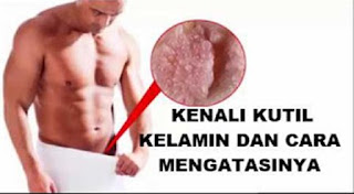 Obat menghilangkan nyeri kutil kelamin, cara menghilangkan kutil kelamin atau kutil di kemaluan pada wanita, cara alami menghilangkan kutil pada kelamin, cara penyembuhan kutil pada kemaluan pria, mengobati kutil kelamin atau kutil di kemaluan dengan bawang putih, obat kutil kelamin yg aman buat ibu hamil, cara herbal mengobati kutil kelamin, obat mengatasi kutil kelamin, cara menghilangkan kutil di dekat kemaluan, penyebab kutil di alat kelamin, obat kutil kelamin atau kutil di kemaluan/jengger ayam