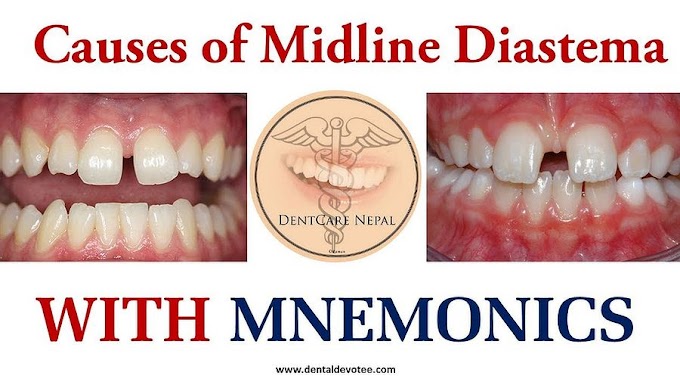 MIDLINE DIASTEMA: Causes with Mnemonics - Dental Spacing Causes