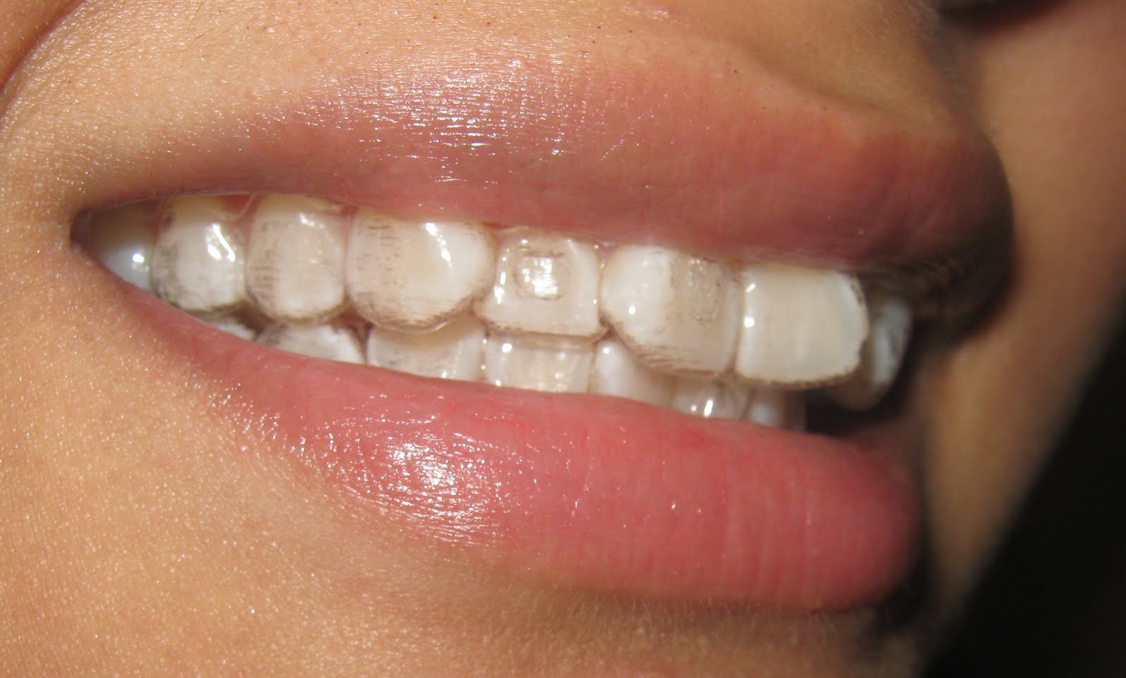 invisalign tray attachments teeth ndy br journey