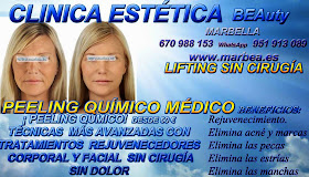 MARBELLA PEELING FACIAL QUIMICO MEDICO PARA ELIMINACIÓN , QUITAR , TRATAMIENTO: ACNÉ , MARCAS , CICATRICES , MANCHAS ,PECAS , ESTRÍAS , MANCHAS