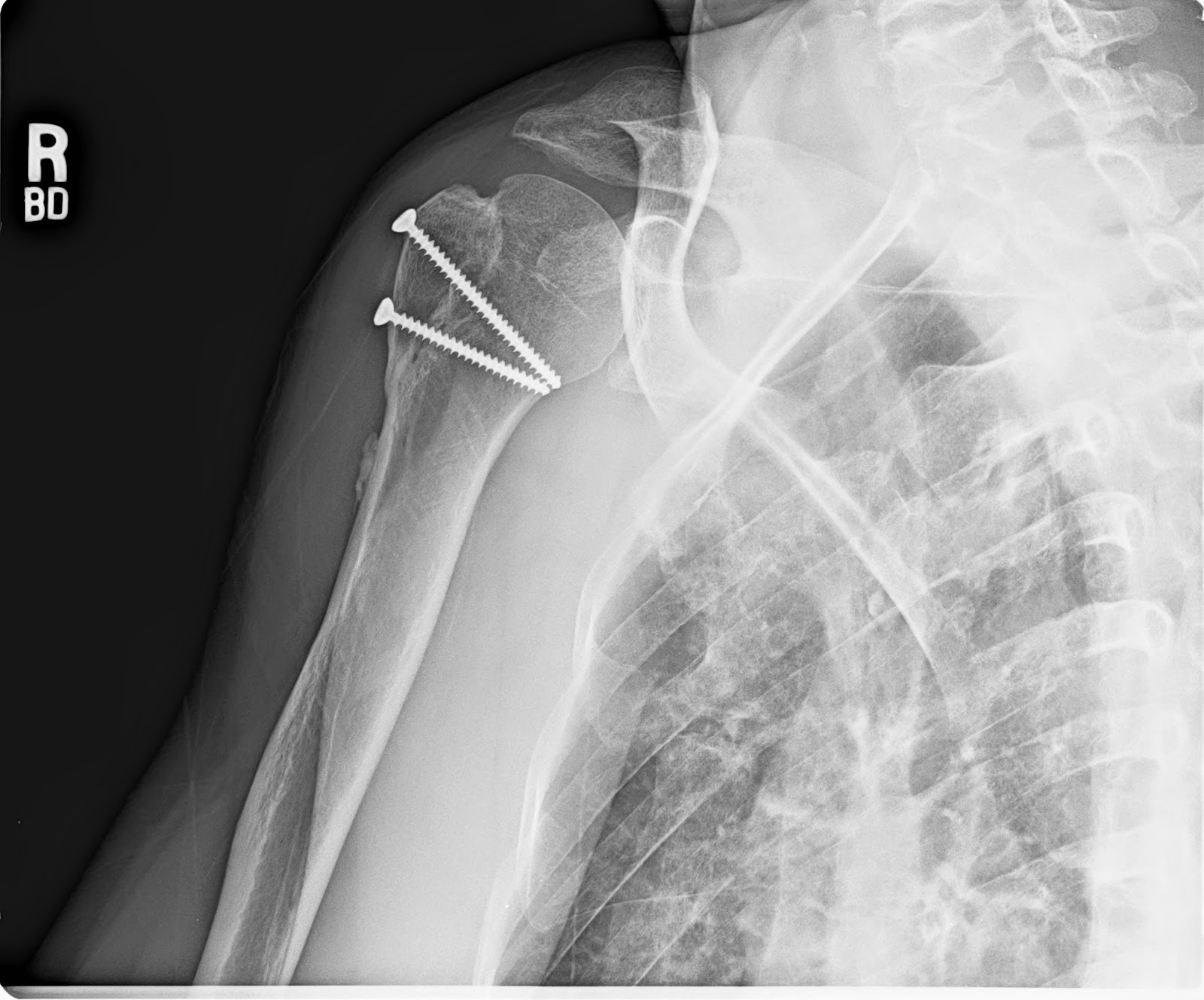 Comminuted fracture greater tuberosity humerus - virinsights
