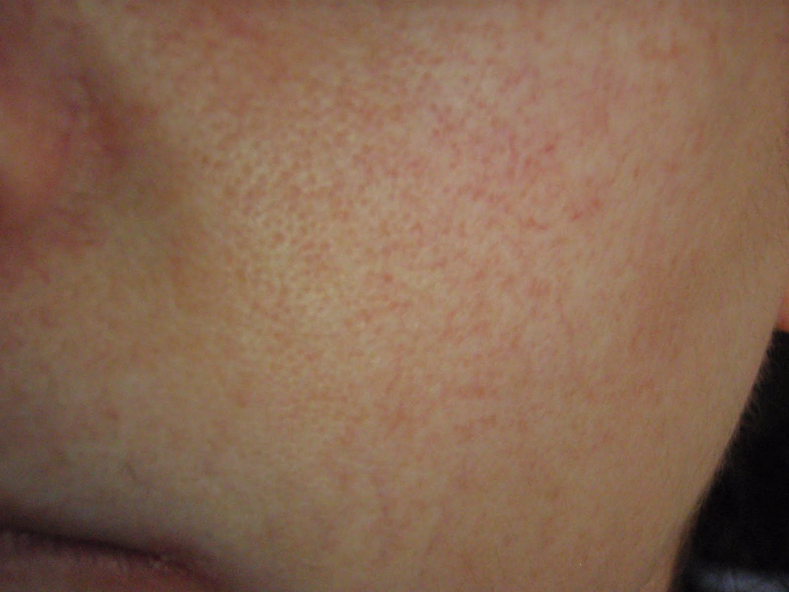 Princess Lupus: The Things I Hide About my 