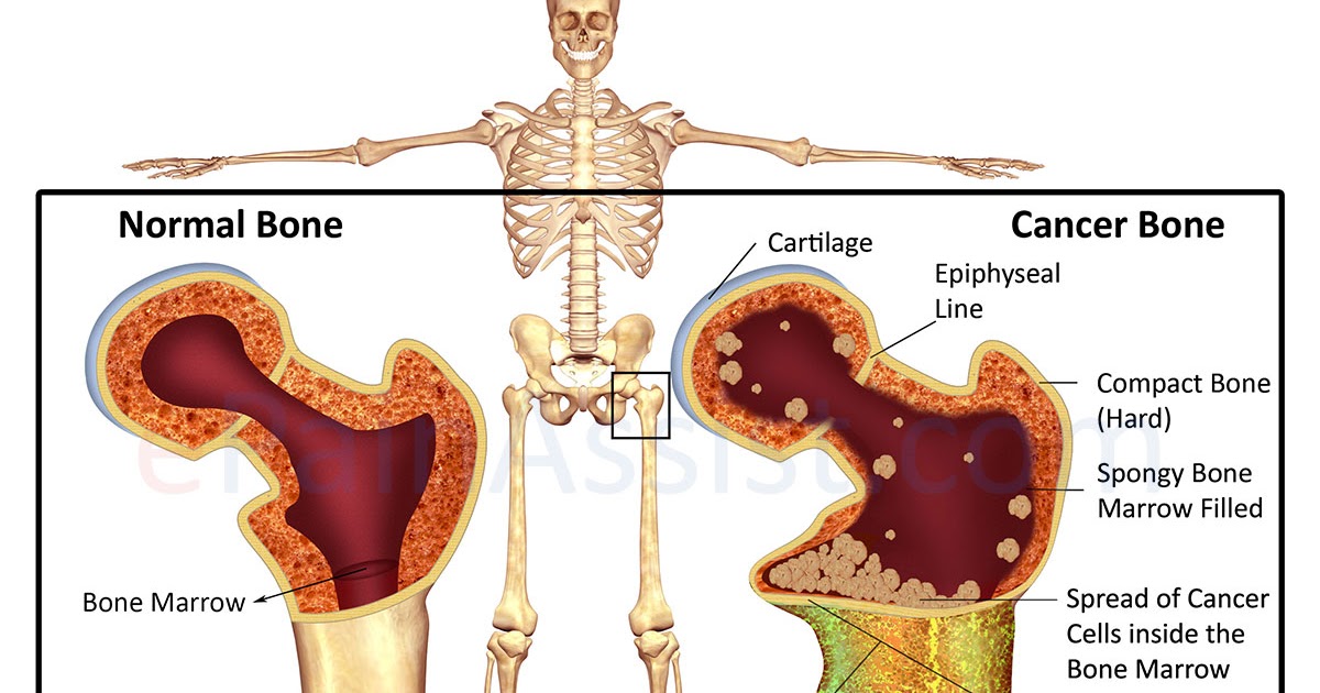 Bone cancer treatment in India