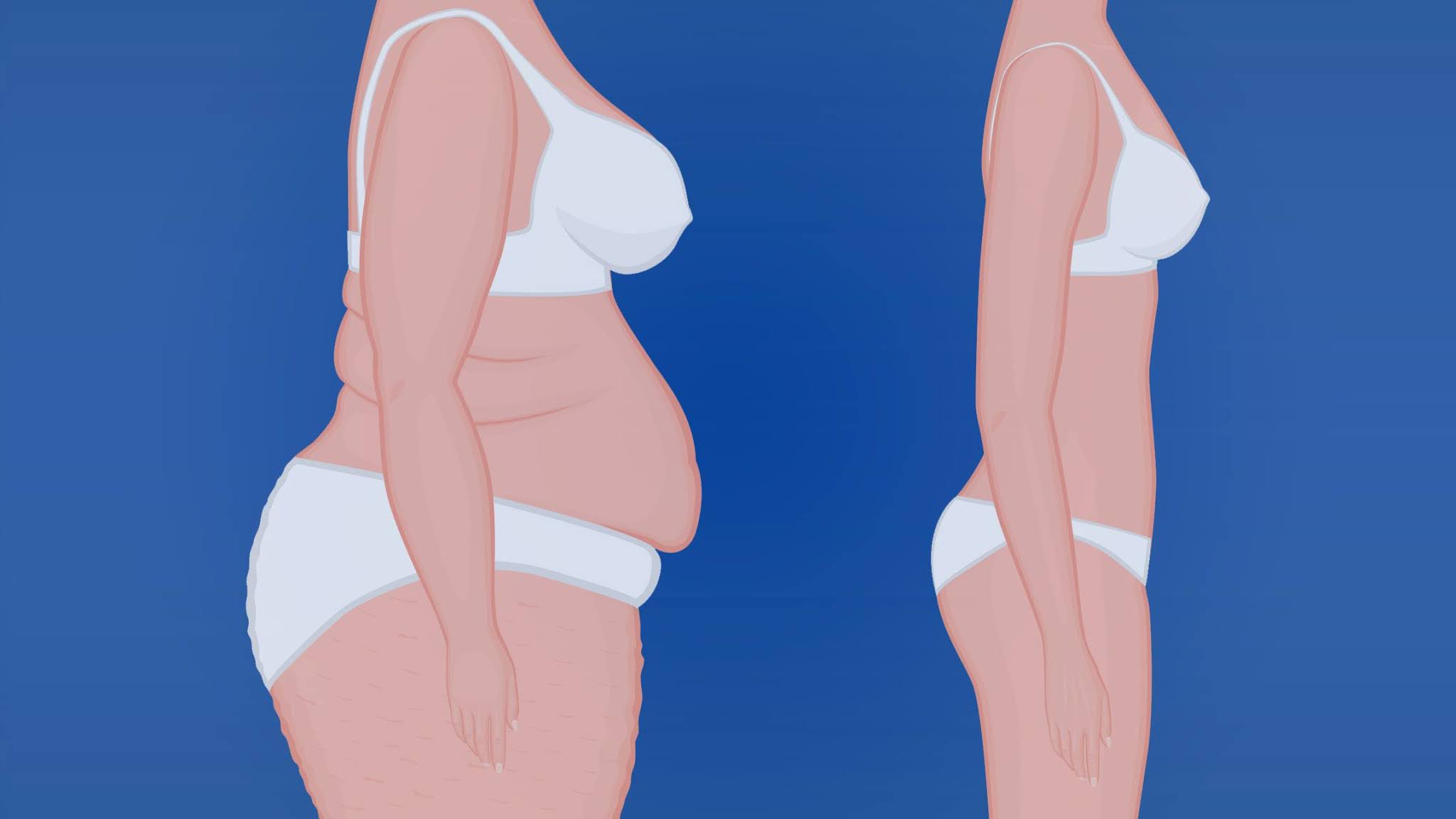 Pregnancy and Weight Loss Surgery