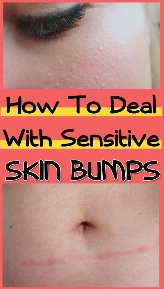 How To Deal With Sensitive Skin Bumps? Healthy Lifestyle