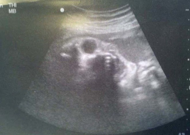foto usg bayi paling mengerikan dan juga menyeramkan yang membuat bulu kuduk berdiri-6