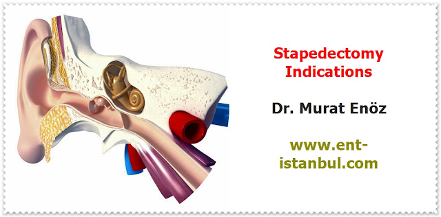 Stapedectomy Operation - Total Stapedectomy - Partial Stapedectomy - Stapedotomy - Stapedial Ankylosis - Preoperative Diagnostic Procedures For Stapedectomy - Indications For Stapedectomy Operation - Contrandications For Stapedectomy Operation - Stapedectomy Technique - Stapedectomy by using Titanium Piston - Stapedectomy Risks & Complications - Postoperative Patient Care For Stapedectomy