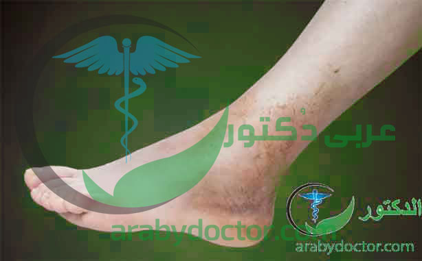 التواء الكاحل| اسبابه وتشخيصه وطرق منع حدوثه التواء الكاحل| اسبابه وتشخيصه وطرق منع حدوثه