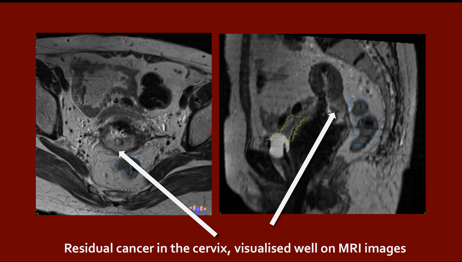 cancerradiotherapyinfo Modern radiation techniques for treating