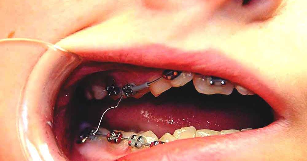 sore poking emergencies orthodontic