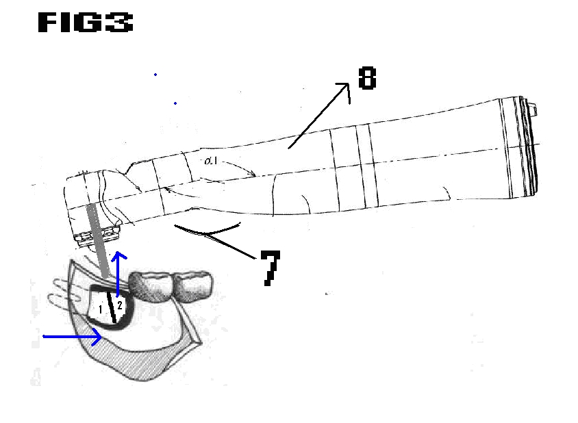 NAG's Method- A New Method Of Third Molar Removal ?!?!: NAG’s Method ...