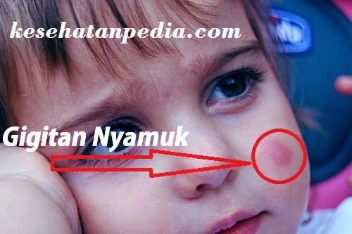 Cara Menghilangkan Bekas Gigitan Nyamuk pada Bayi secara Alami