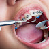 Niềng răng móm hiệu quả khi nào?
