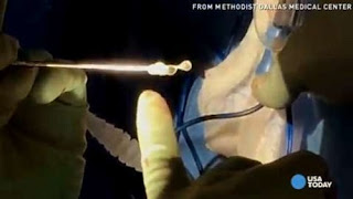 Gjenden larva krimbash në trurin e 31-vjeçares, konsumoi ushqim të kontaminuar me fekale
