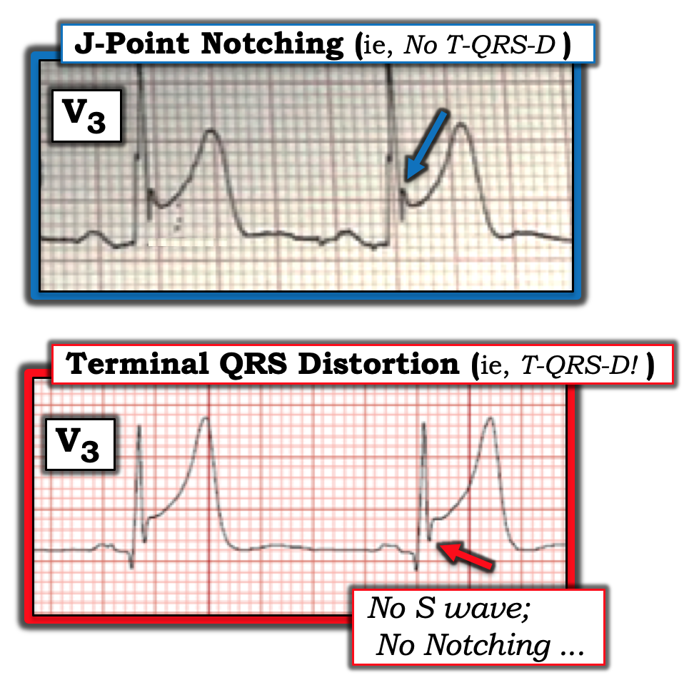 экг 1 отведение норма. плохой ход зубца. зубцы и интервалы экг нормы. плохой ход зубца. нормы зубцов экг таблица.